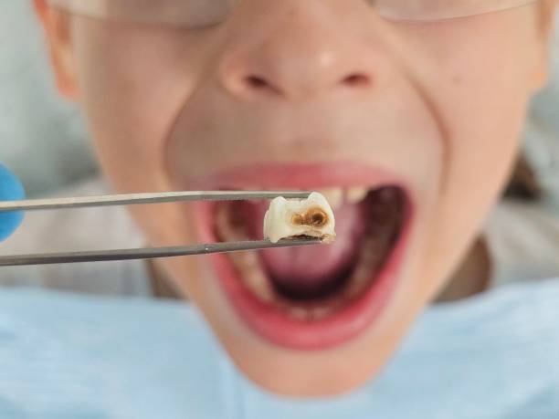 Best Emergency Dentist for Lost Fillings or Crowns in Burt, MI