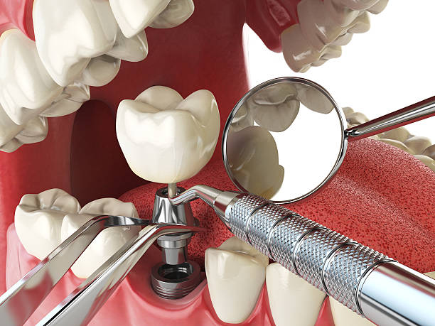 Best Emergency Dental Extractions in Burt, MI